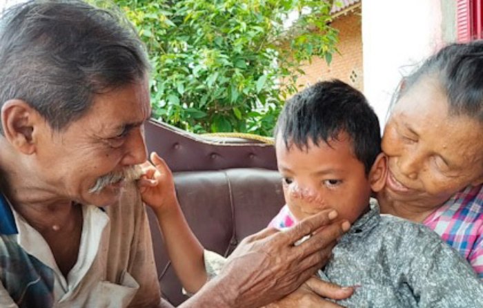 Dilan bocah malang pengidap tumor wajah, ditengah pangkuan kakek dan neneknya, dia harus merasakan sakit sendiri karena sang ibu tega meninggalkannya sejak umur 40 hari