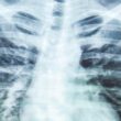 6 Tanda Penyakit Paru-paru Basah untuk Deteksi Dini
