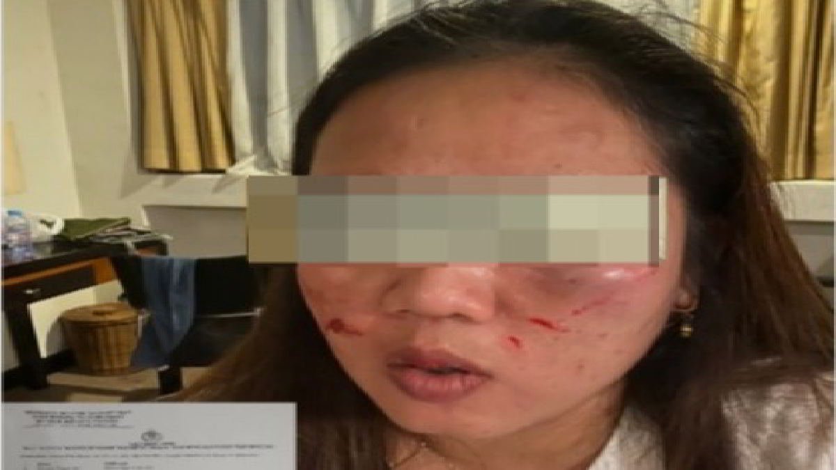 Penampakan RY staf honorer DPRD Tanggamus penuh luka cakar dan memar usai mendapat penganiayaan rekan sendiri saat tengah berada di Jakarta dalam rangka pendampingan anggota Dewan yang tengah melaksanakan Kunker Senin 25 Maret 2024