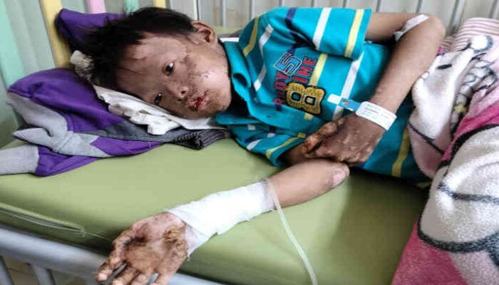 Duduk di Bangku Kelas 3 SD, Idap Penyakit Langka: Adik Solihin Butuh Uluran Tangan Dermawan