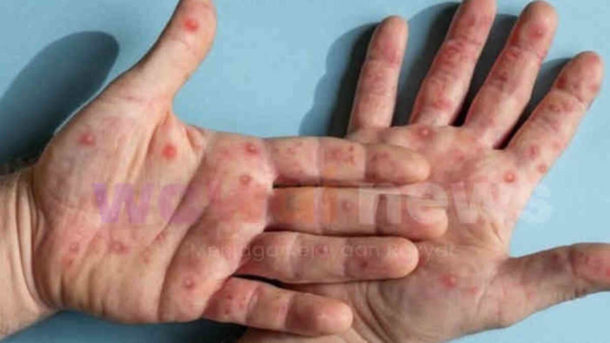 Mudik Lebaran 2026 Dibayangi Ancaman Campak, Kasus di Jawa Barat Tembus Ribuan