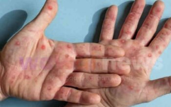 Mudik Lebaran 2026 Dibayangi Ancaman Campak, Kasus di Jawa Barat Tembus Ribuan