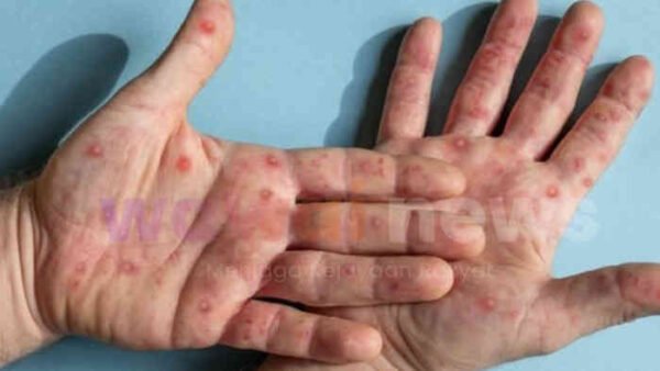 Mudik Lebaran 2026 Dibayangi Ancaman Campak, Kasus di Jawa Barat Tembus Ribuan