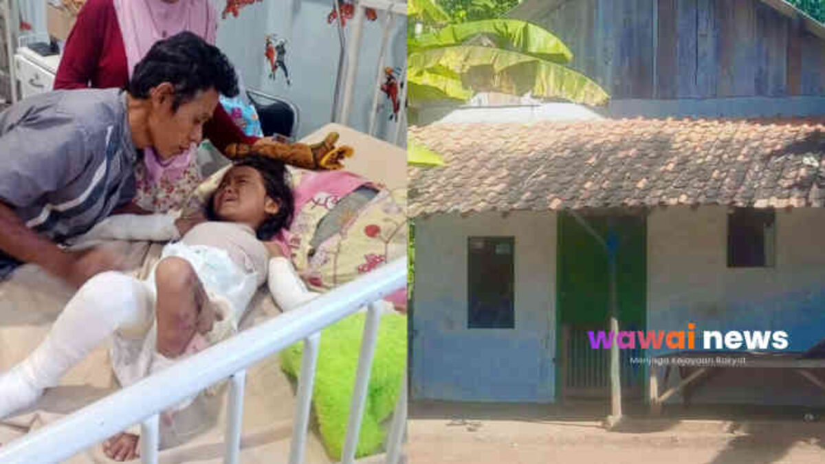 Ulfa Terbakar 70 Persen Tubuhnya, Anak 4 Tahun dari Keluarga Disabilitas Ini Berjuang Melawan Rasa Sakit dan Kemiskinan